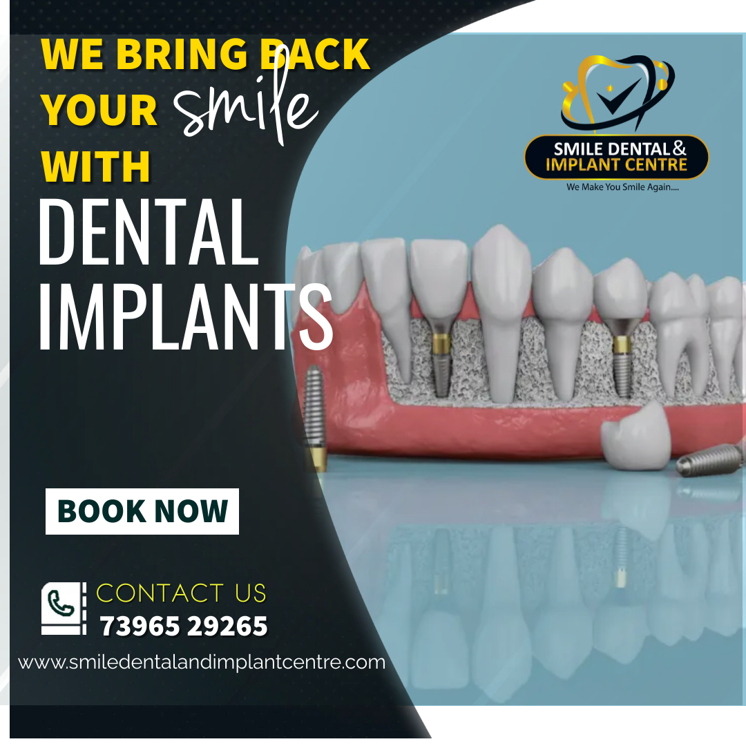 what-is-the-full-mouth-dental-implants-cost-in-hyderabad-dentistry